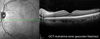 OCT gesunde NEtzhaut